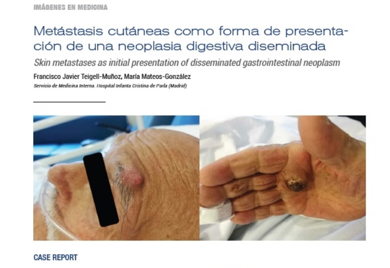 “Metástasis cutáneas como forma de presentación de una neoplasia digestiva diseminada” | Francisco Javier Teigell Muñoz y María Mateos González, Medicina Interna